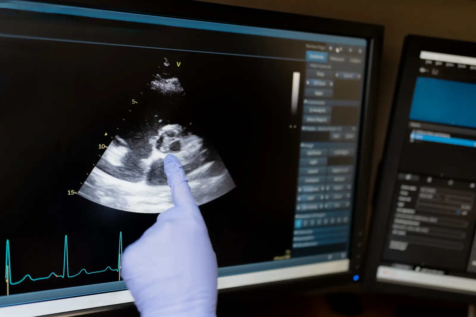 A gloved hand points to an echocardiogram image of the heart on a monitor, with an ECG tracing below.